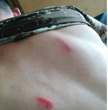 网络暴力事例_纳吧_山东爱国青年被群殴 头部缝了两针 背部红肿