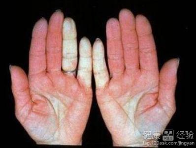 孕妇可出现冷凝集素吗_冷凝集素_冷凝集试验阳性