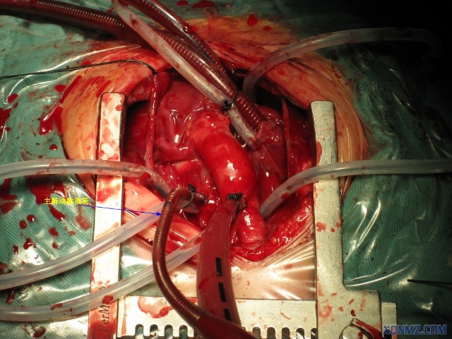 大动脉转位费用_switch_大动脉转位成功率