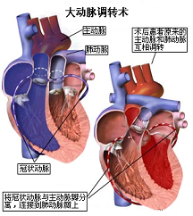 大动脉转位费用_switch步骤_switch