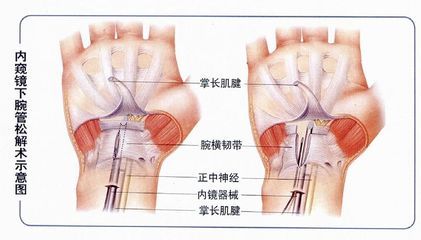 鼠标手的最好治疗方法