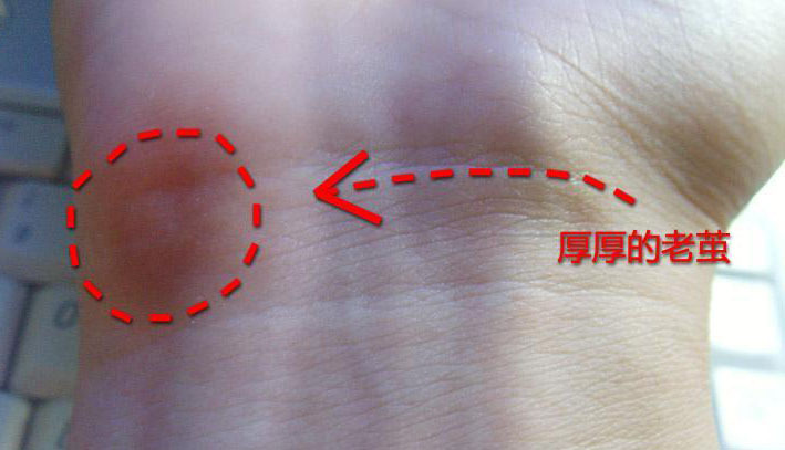 麦塔奇保手派三代人体工学鼠标让人疼痛麻木
