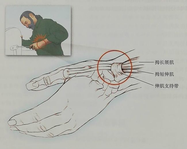 人体工程学鼠标好还是对称鼠标好_治疗手湿疹最好方法_鼠标手的最好治疗方法